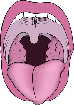 Images of adenoids-growth of lymphoid tissue of the nasopharyngeal tonsil. Image of a mouth with a protruding tongue and adenoids.