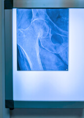 Luminous X-ray viewer with X-ray femur fracture and the bones of the pelvis