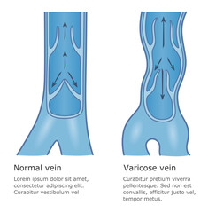 Varicose and normal vein illustration