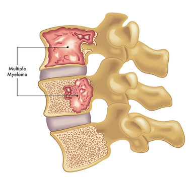 Medical illustration of two vertebrae of the spine affected by multiple myeloma