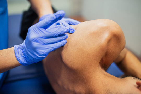 From above of crop faceless sports medicine doctor in sterile gloves inserting thin needle in the back of unrecognizable male patient in underwear lying on examination couch during acupuncture process