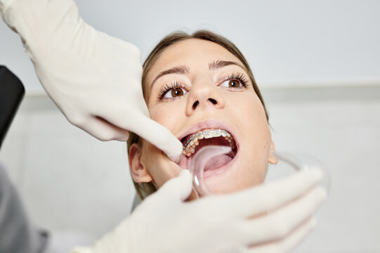 From above of crop faceless doctor placing dental retractor in mouth of female patient with braces in hospital