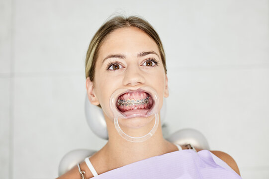 From above of adult woman with napkin on chest wearing braces and sitting in chair with dental retractor in mouth under bright lamp light
