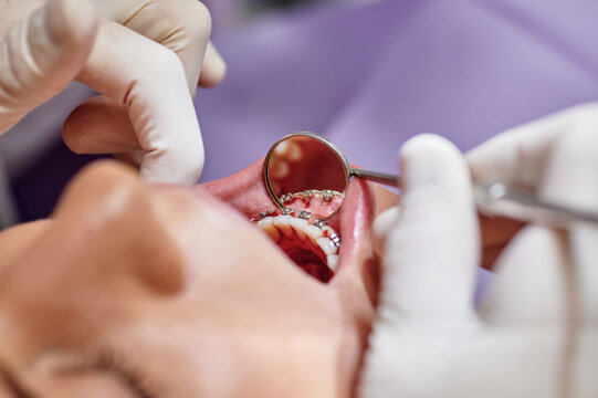From above of faceless dental doctor checking teeth of female client wearing braces while using mouth mirror