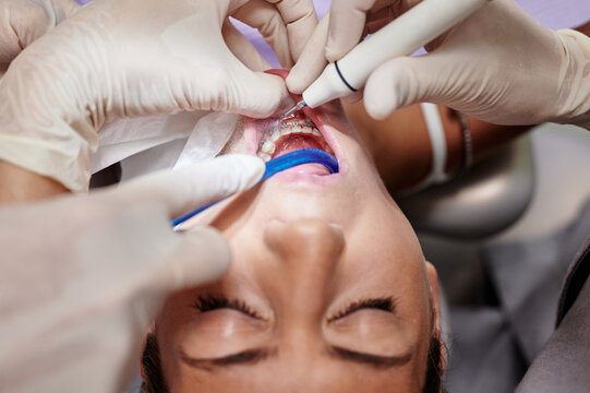 From above of crop patient with braces having cleaning procedure in modern dental clinic