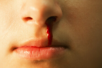 Bleeding through the nose of a girl close up. Healthcare and medical concept