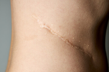 surgery scar after kidney pyelonephritis. after remove kidney operation. caucasian person close up...