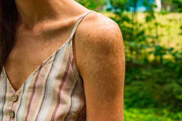 White caucasian women with skin problem disease in garden, perfectly imperfect girl