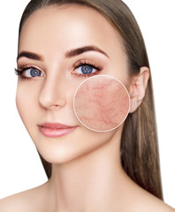 Young woman with couperose on face skin.