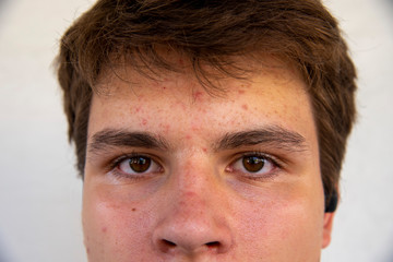 Close-up of the face of a young man suffering from acne.