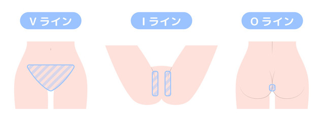 脱毛箇所　VIO　デリケートゾーン