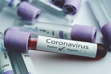 Blood test samples for presence of coronavirus (COVID-19) tube containing a blood sample that has tested positive for coronavirus. Covid-19 concept.