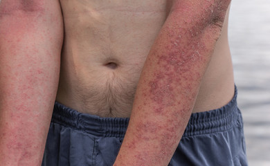 Dyshidrotic autoimmune eczema of patient. Concept of health care