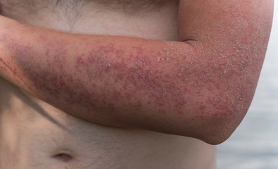 Fototapeta premium Dyshidrotic autoimmune eczema of patient. Concept of health care