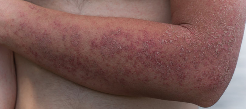 Dyshidrotic autoimmune eczema of patient. Concept of health care