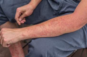 Dyshidrotic autoimmune eczema of patient. Concept of health care