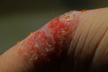 重度のアトピーに苦しむアレルギーを持つ男性の血だらけの皮膚と指
