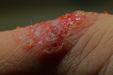 重度のアトピーに苦しむアレルギーを持つ男性の血だらけの皮膚
