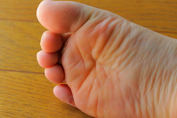 重度の水虫に苦しむアレルギーを持つ男性の足と指
