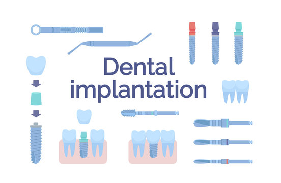Dental tools for dental implants. Medical metal and titanium. Vector illustration, in a flat style. Poster to the clinic, image for instructions for dentists, training books. Isolated on white.