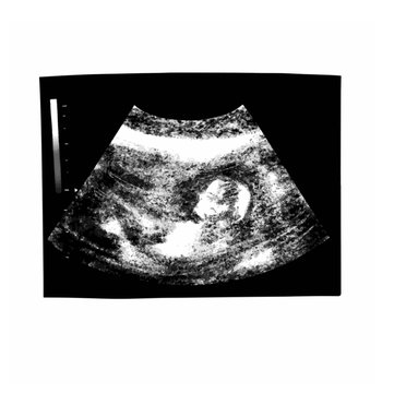 Huge ultrasound picture in mother's womb. Vector illustration in black and white ultrasound Image. Medical and Health of the fetus . Realistic embryo sonogram