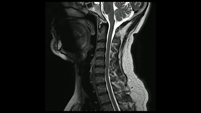 Magnetic Resonance images of Cervical spine sagittal T2-weighted images in Cine mode (MRI Cervical spine) showing Multiple disc disease, more evident at C5-6 disc.