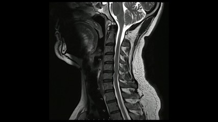 Magnetic Resonance images of Cervical spine sagittal T2-weighted images (MRI Cervical spine) showing Multiple disc disease, more evident at C5-6 disc. - obrazy, fototapety, plakaty