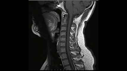 Magnetic Resonance images of Cervical spine sagittal T1-weighted images (MRI Cervical spine)...