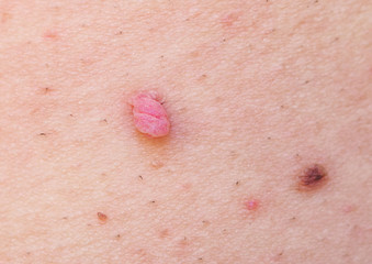 Large papilloma and a mole on the skin of the armpit. Human Papilloma Virus.