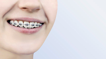 The smile of a young girl with braces on her white teeth. Teeth straightening. Malocclusion. Dental care.