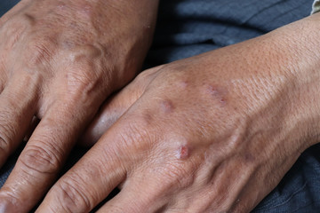 Fototapeta premium Hand infected. Hand foot and mouth disease HFMD. Allergic