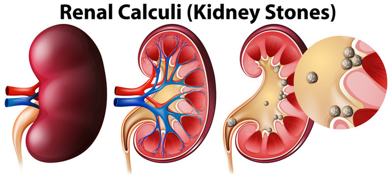 Anatomy of kidney and kidney stones