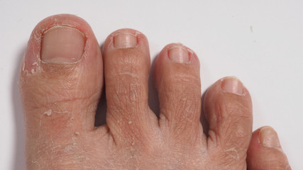 Foot peeling or remove dead skin on white background.