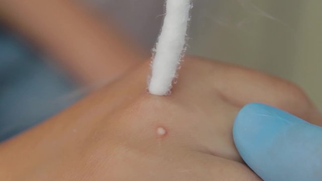 Woman doctor removes wart on boy's arm with liquid nitrogen.