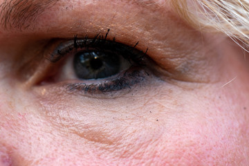 crows feet and a mole around a mature woman eye 