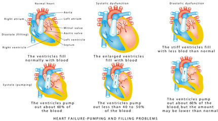 Heart failure. Heart Failure - Pumping and Filling Problems,  Systolic Dysfunction, Diastolic Dysfunction. Heart failure or congestive heart failure. Diseases of the Heart. 