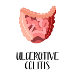 Ulcerative colitis. Intestines diseases. Gastroenterology. Vector flat illustration. Perfect for flyer, medical brochure, banner, landing page, website