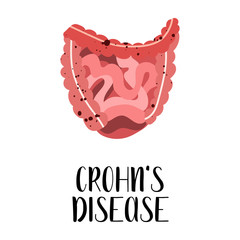 Crohn's disease. Intestines diseases. Gastroenterology. Vector flat illustration. Perfect for flyer, medical brochure, banner, landing page, website - 371948621