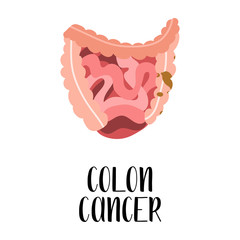 Colon cancer. Oncology. Intestines diseases. Gastroenterology. Vector flat illustration. Perfect for flyer, medical brochure, banner, landing page, website