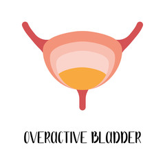 Overactive bladder. Urinary system disease. Urology. Vector flat illustration. Perfect for flyer, medical brochure, banner, landing page, website