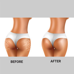 before and after of stretch marks on woman's buttocks