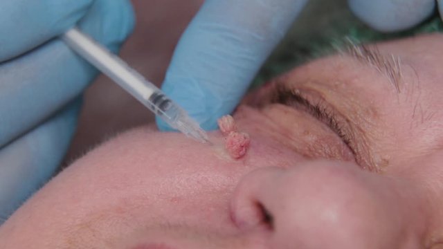Male doctor removes papillomas of an elderly woman with an electric scalpel.