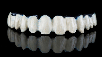 titanium bar of the upper jaw for creating a metal-ceramic prosthesis