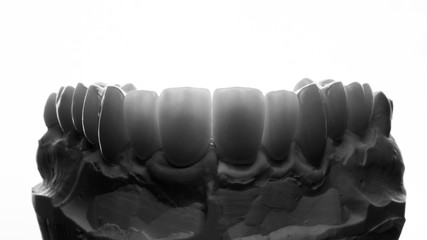 creative photo of dental veneers on the model of the upper jaw, photo in black and white style on a white background © Dental Pro Content