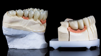 dental model of the upper jaw with ceramic veneers and model of the lower jaw with temporary crowns © Dental Pro Content