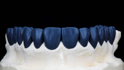 technical wax-up of the upper jaw plaster on a black background