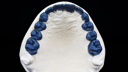 technical wax-up made of blue material of the upper jaw. top view of morphology © Dental Pro Content