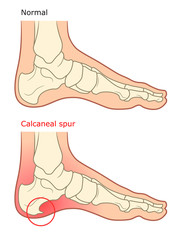 Calcaneal spur illustration. Healthy foot and diseased foot with spur.  - obrazy, fototapety, plakaty