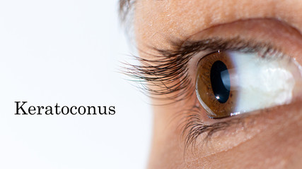 Macro eye photo. Keratoconus - eye disease, thinning of the cornea in the form of a cone. The...