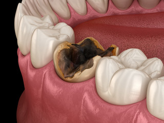 Molar tooth damaged by caries. Medically accurate tooth 3D illustration.
